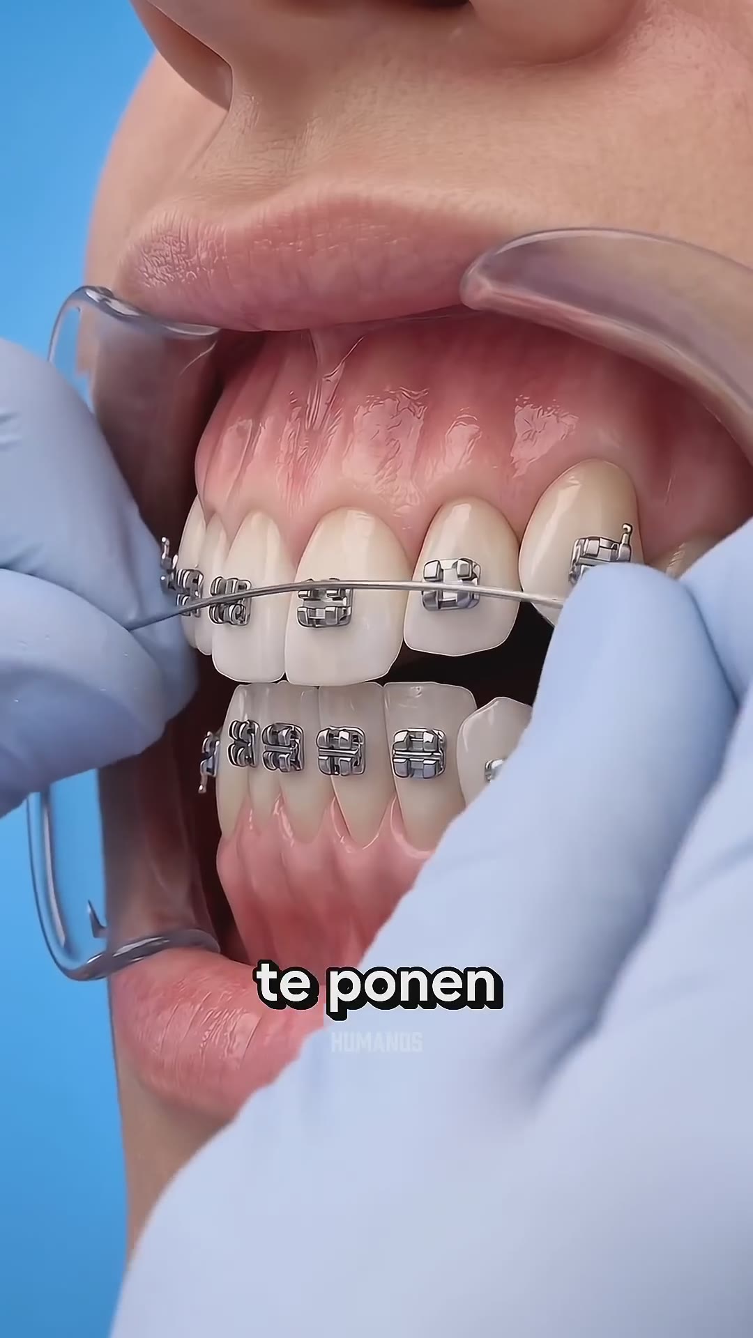 ¿Por qué duelen tanto los DIENTES cuando te ponen brackets? 😬🦷 #brackets #ortodoncia